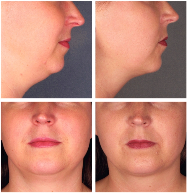 Belkyra ® / Kybella ® Fat dissolving injections 