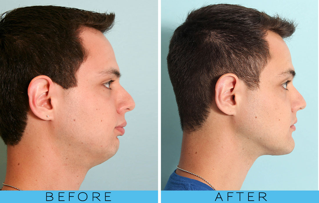 CHIN RESHAPING