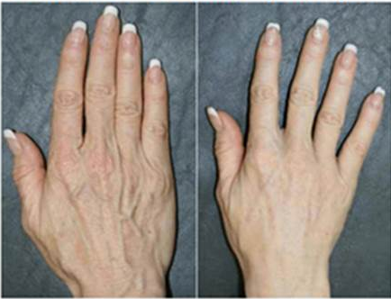 Hand Rejuvenation