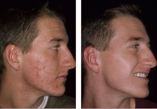 Scar Treatment