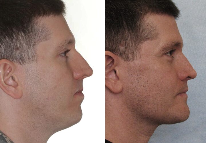 Jaw Contouring