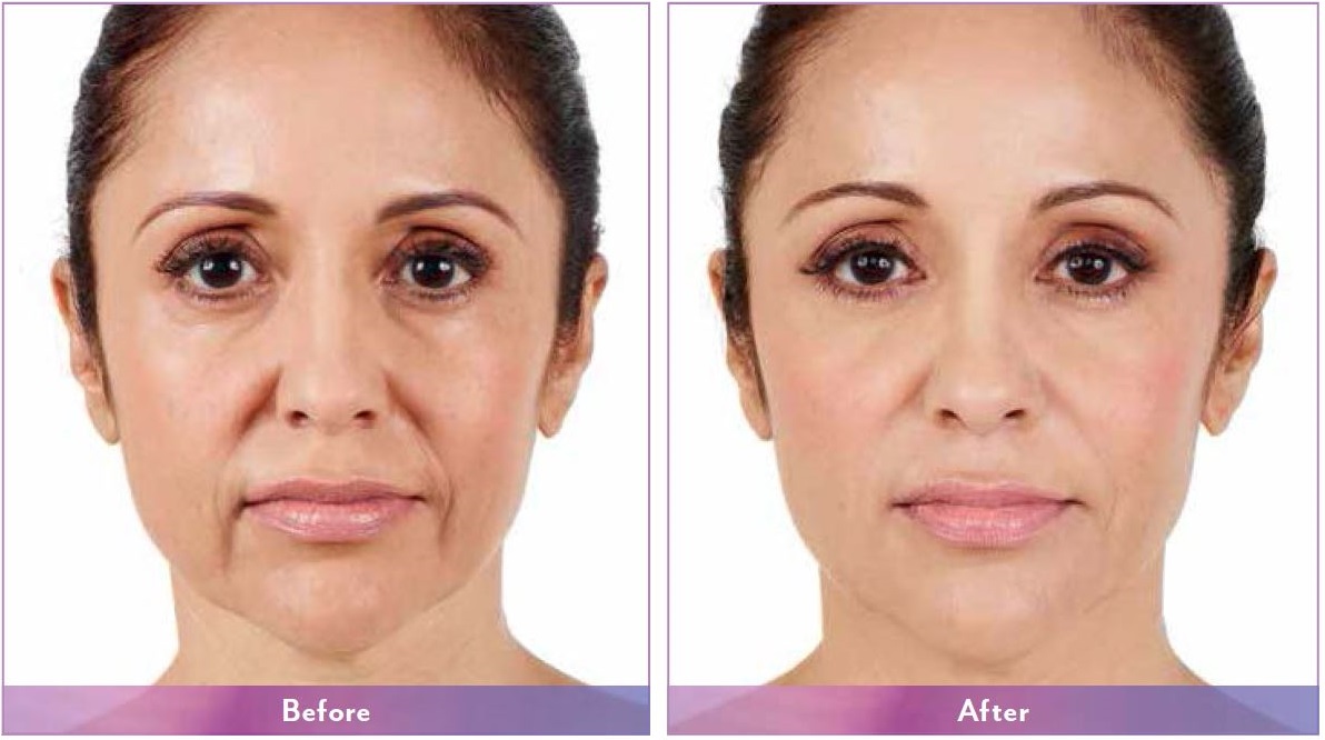 Juvederm® Range