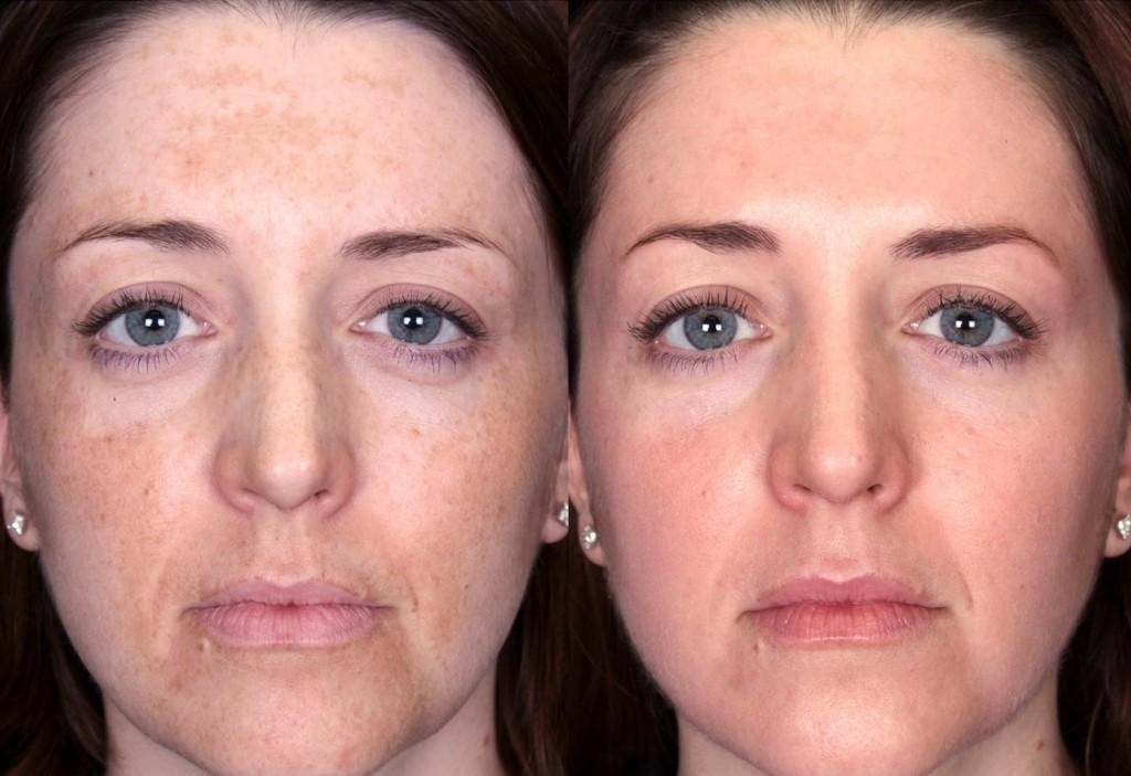 Melasma Cholasma