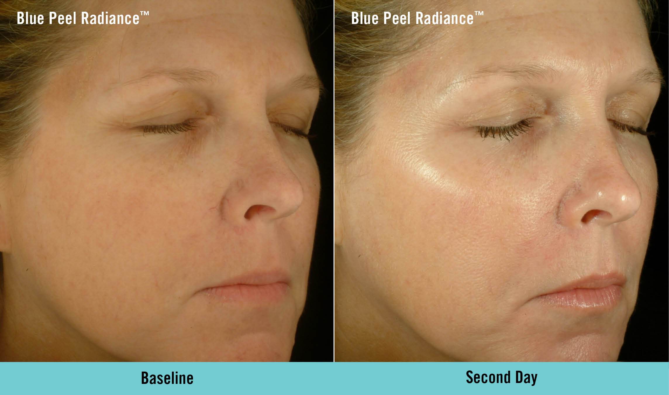 Obagi Blue Peel