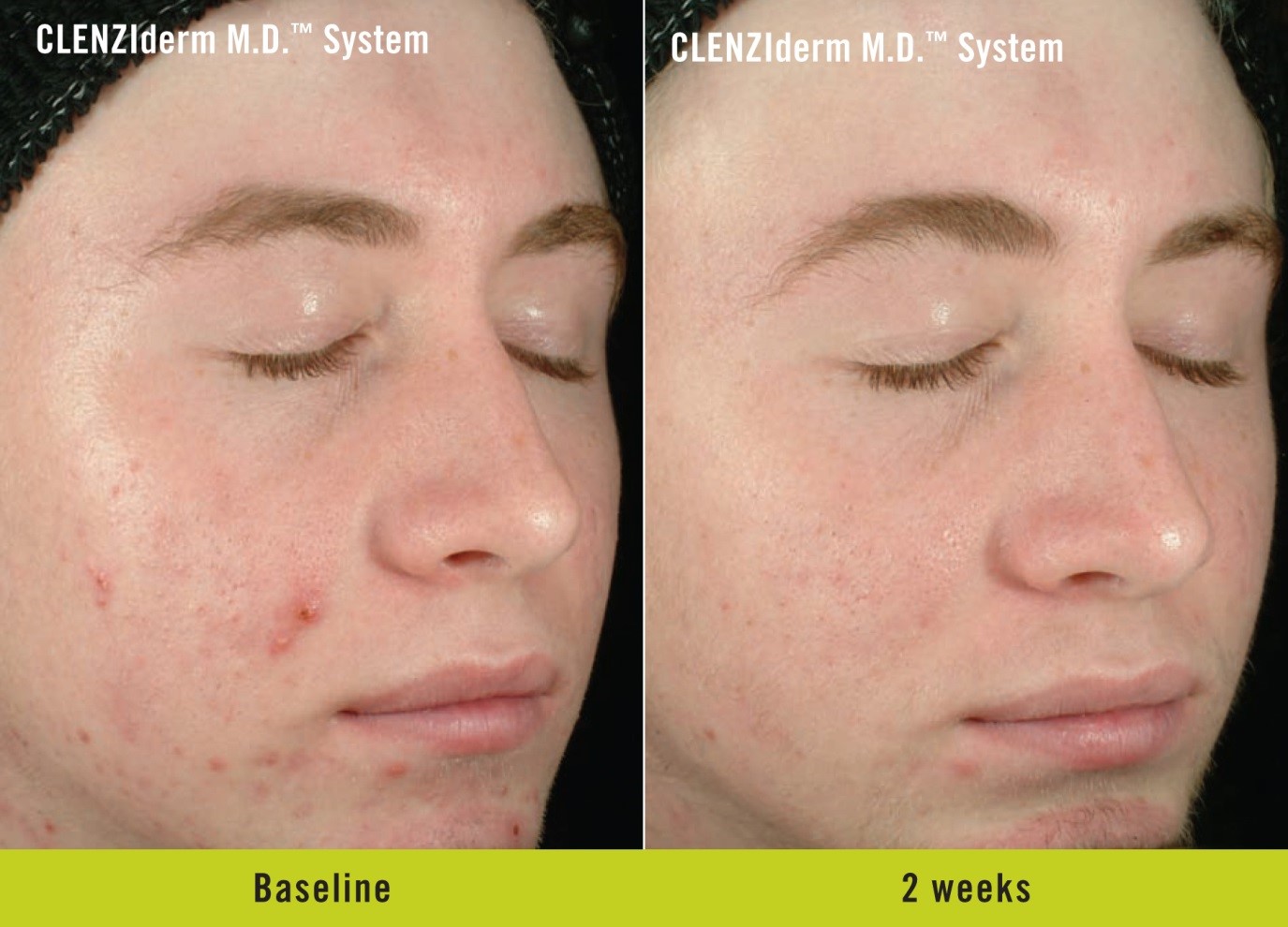 Obagi CLENZIderm M.D. System