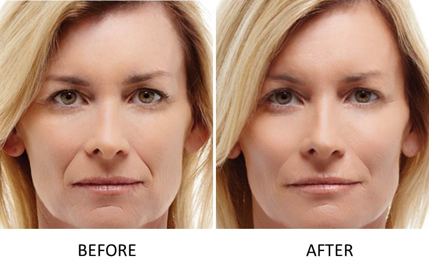 Radiesse® Volumising Filler 