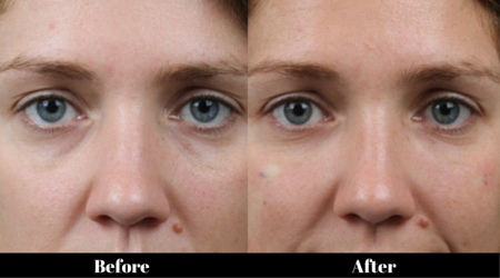 Tear Trough and Eye Bag Correction